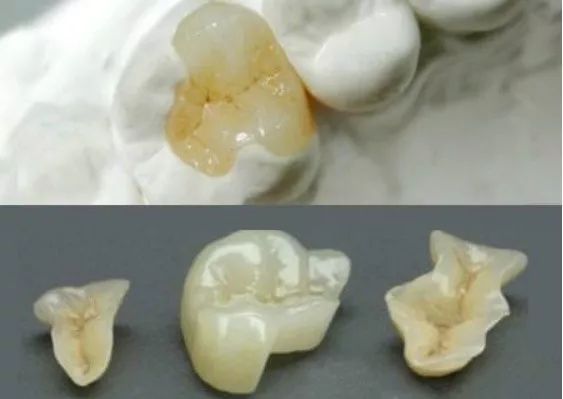 门牙补牙用什么材料最好,补牙的材料选哪种更好