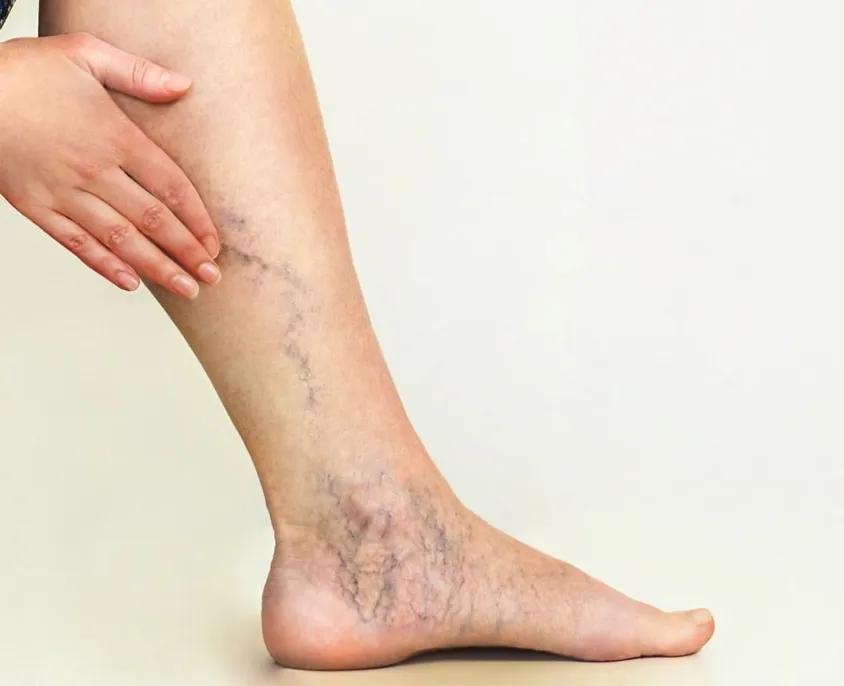 压力袜瘦腿袜真的有用吗,加压袜的功效与作用