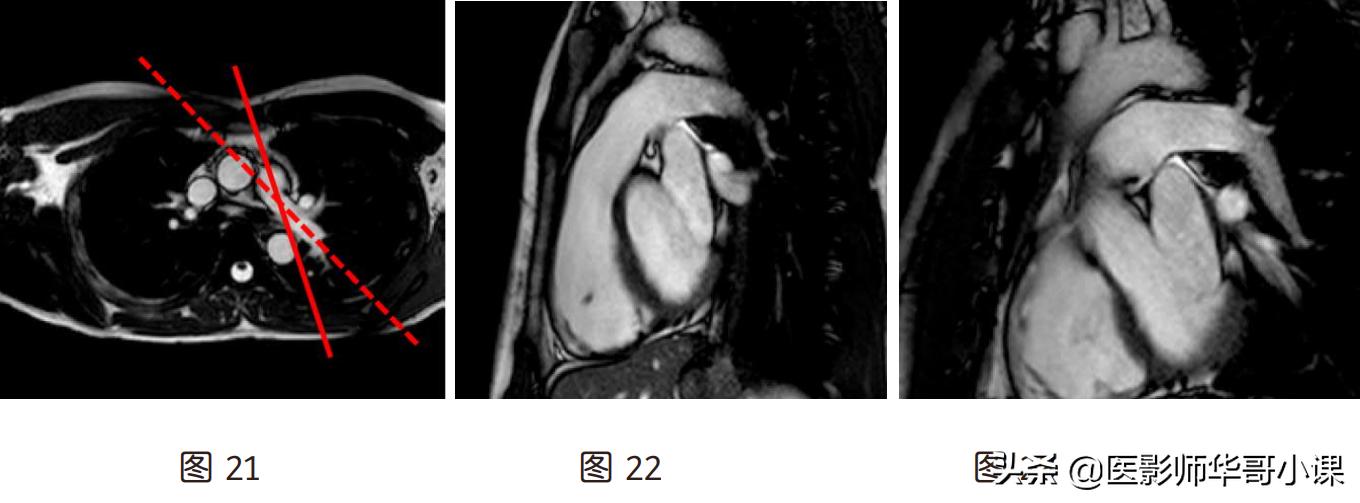 磁共振心脏扫描标准切面,心脏mri扫描定位