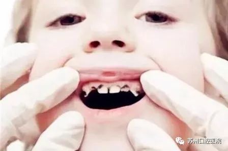 乳牙蛀牙清除真实全过程,小儿乳牙龋齿民间治疗偏方