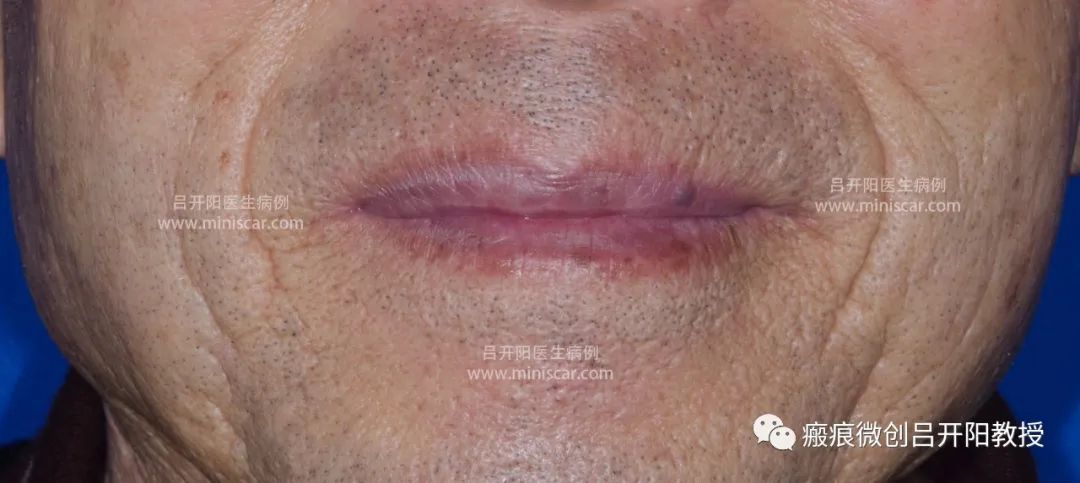 强脉冲激光治疗脸部视频,点阵激光嫩肤