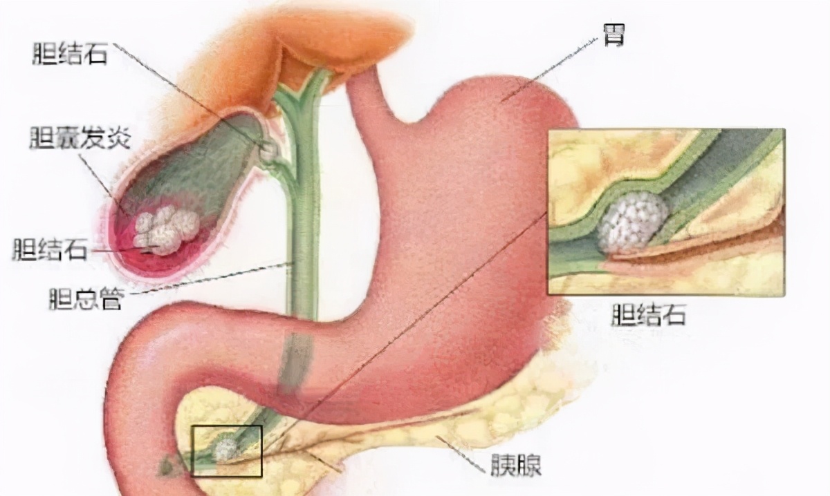 带你学中医科普健康,判断慢性胆囊炎最简单方法