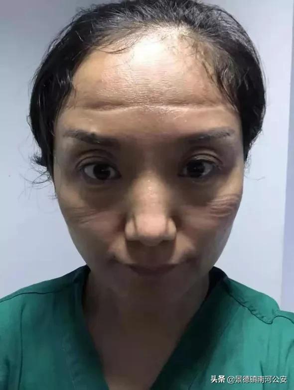 女医护脸上勒痕,最美护士脸上勒痕