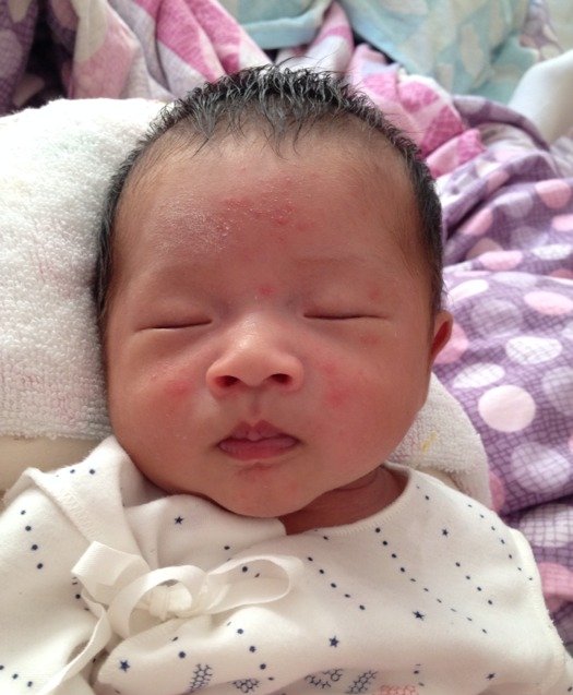 金牌月嫂对新生儿湿疹怎么护理,月嫂湿疹