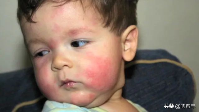 婴儿食物过敏一般多久表现出来,儿童食物过敏的表现和危害