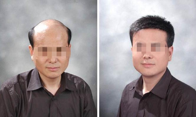 天津美丝特科技增发中心韩医生给您介绍关于织发补发的事情