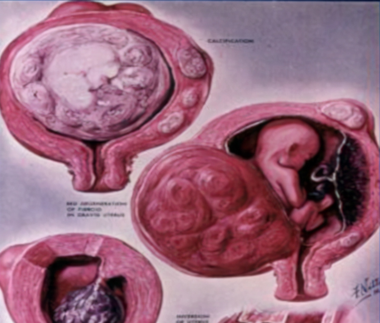 流产会引起子宫肌瘤吗,子宫肌瘤引起流产