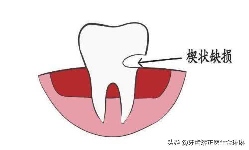 牙齿根部烂掉什么原因,牙总是掉碎块是怎么回事