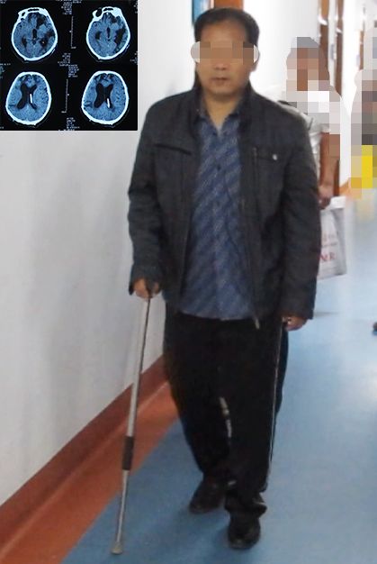 脑外伤开颅手术后脑积水,脑外伤手术后脑脊液鼻漏怎么治疗