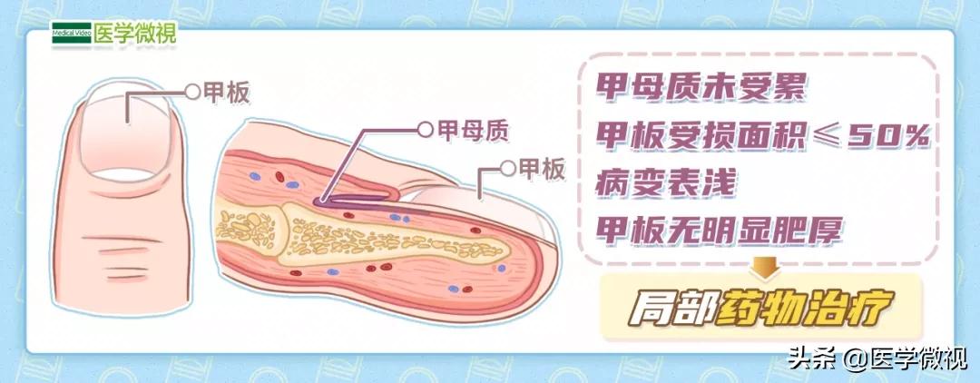 灰指甲三年没治好怎么办,大脚趾灰指甲口服了半年药不见好