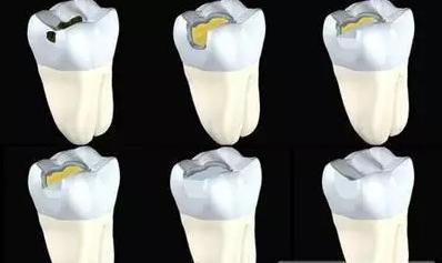 牙齿龋坏补牙能维持多久,牙齿龋坏比较严重补牙效果好吗