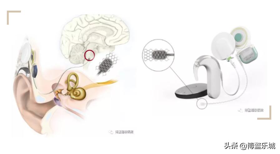 人工耳蜗植入造福更多聋人,博鳌超级医院人工耳蜗植入