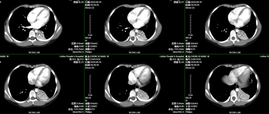 小孩支气管镜取异物技术成熟吗,小儿内镜异物取出术