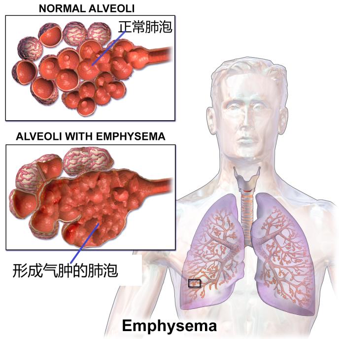 为什么吴邪可以治好肺病,吴邪肺纤维化最后结果