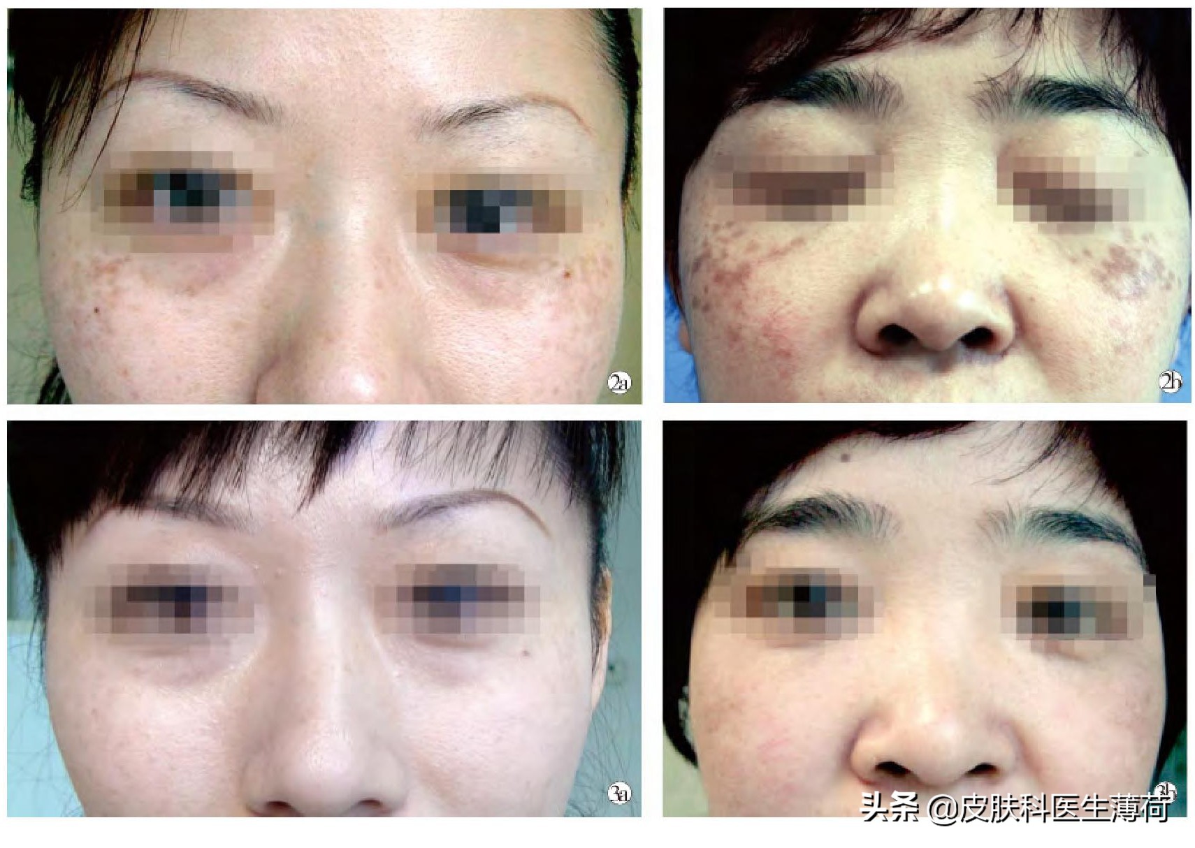 激光点阵祛痘坑收缩毛孔仪器,皮秒激光祛雀斑效果图