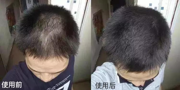 头油头屑痒洗发水,头油头皮屑多脱发洗发水