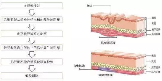 肉毒素注射后多久达到最大效果,肉毒素注射多久就可以看到效果