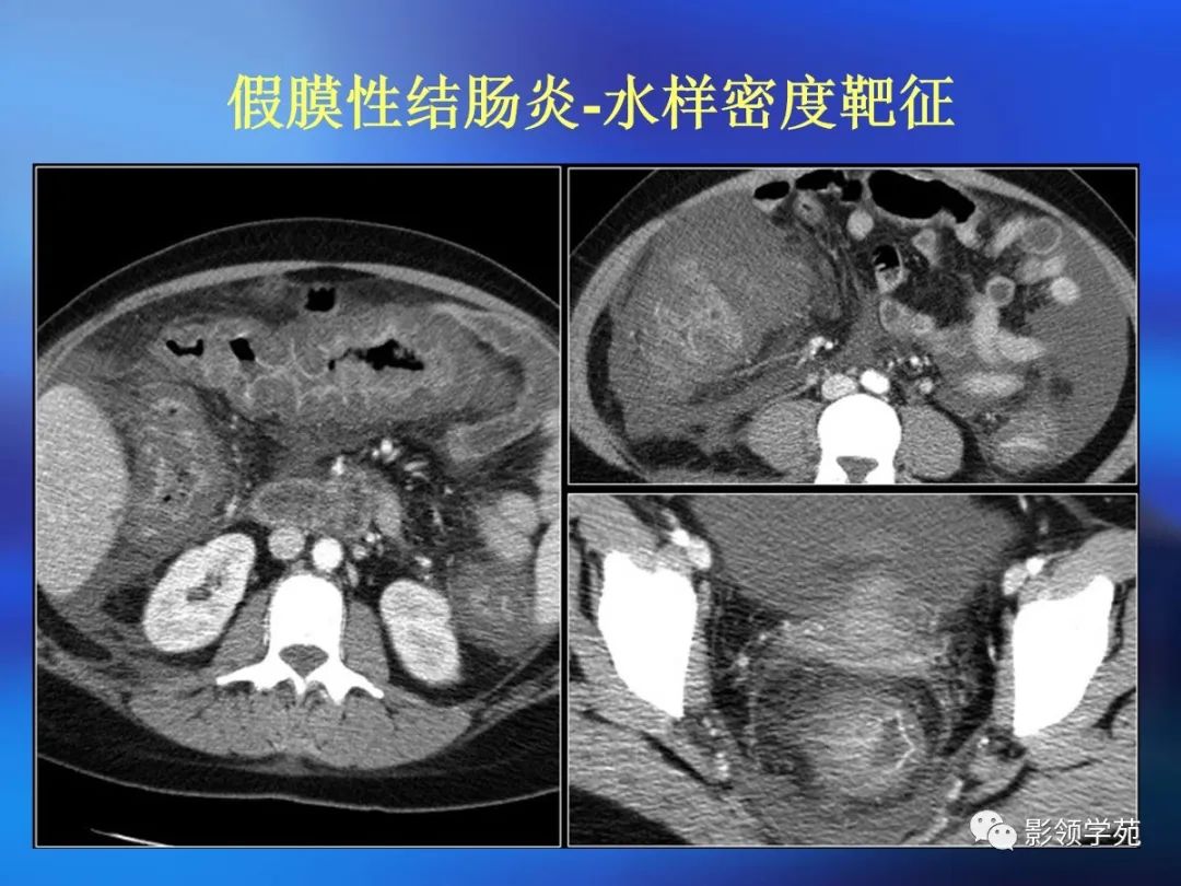 肠道内壁增厚,肠道扩张ct表现