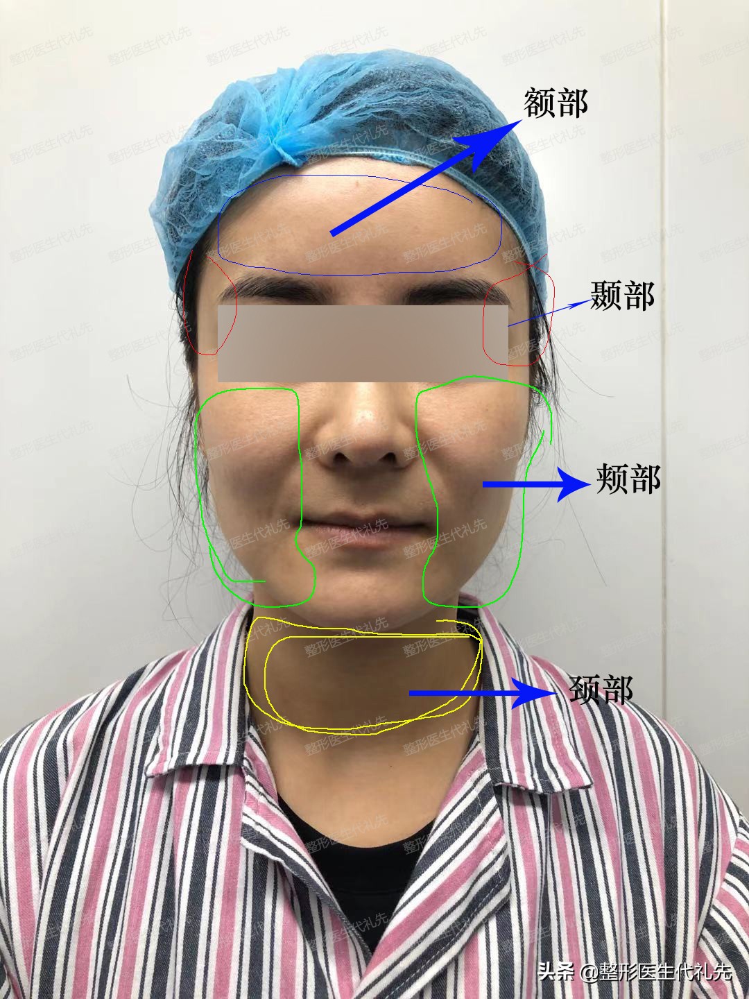 面部提升去皱最有效的方法,全脸提升去皱