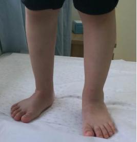 马蹄内翻足孩子的康复,成人马蹄足内翻康复治疗