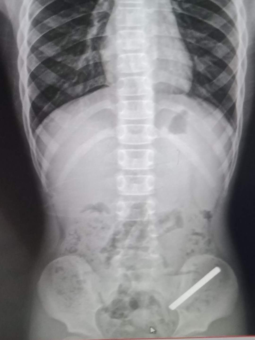 小孩误吞螺丝钉怎么办,二岁小孩误吞螺丝钉几天能拉出来