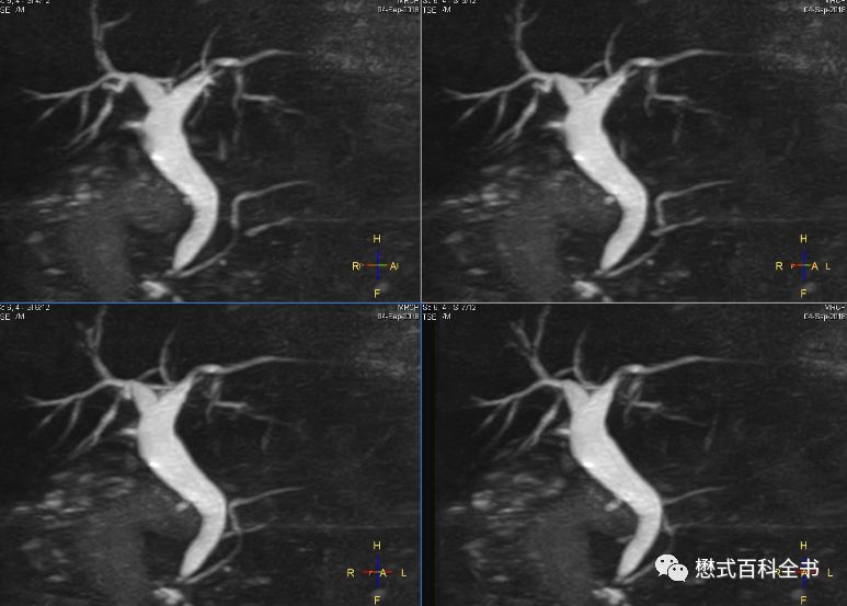开展mrcp技术,mrcp检查操作流程