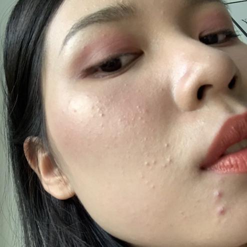 片仔癀淡化痘印凝胶,片仔癀祛痘痘贴有用吗