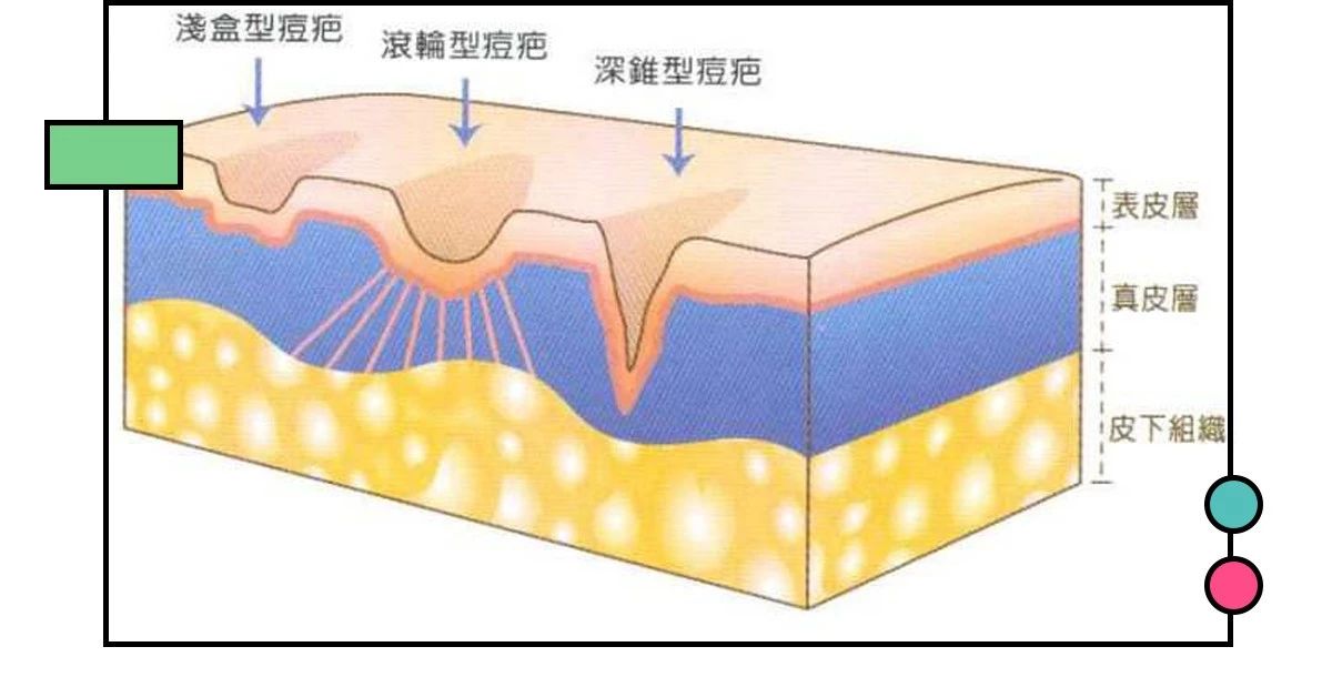 如何祛痘印?看了这篇能解决你大部分的问题!