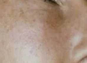 光子嫩肤帮你逆袭光滑细嫩状态,光子嫩肤让你拥有蛋壳般肌肤