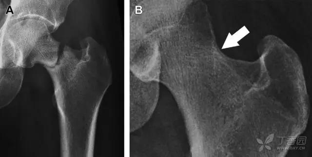 值夜班急救措施,放射科容易漏诊的骨折