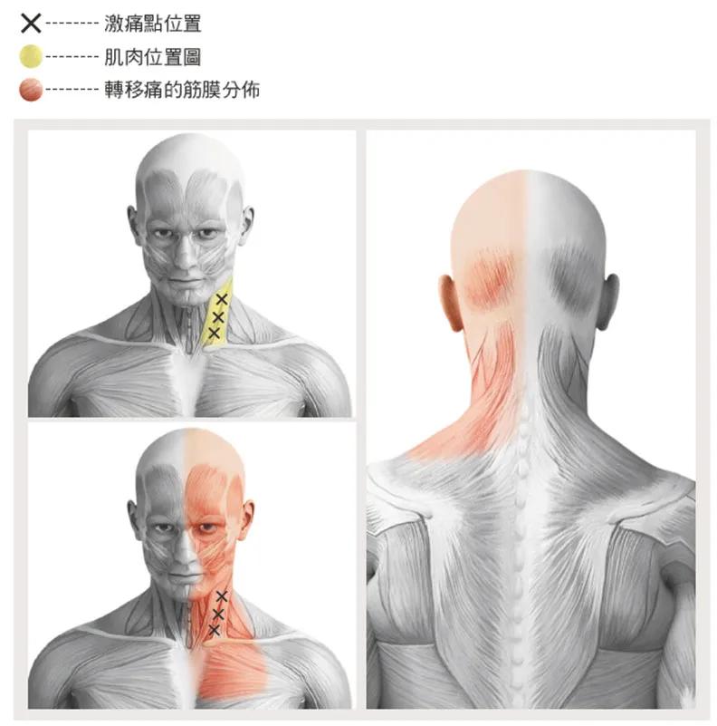 胸锁乳突肌粗大,胸锁乳突肌症状
