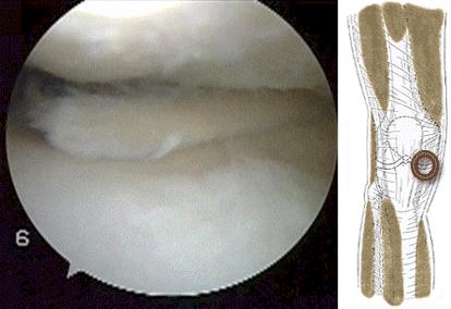 走走路膝盖就软一下怎么回事,走路时一条腿软摔倒怎么回事