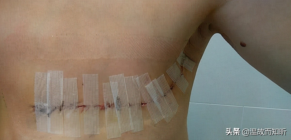 乳头出血是乳腺癌吗,乳房出血是乳腺癌么