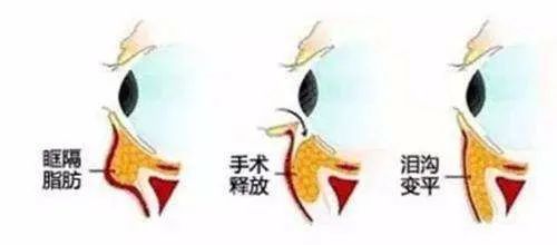 轻医美干细胞填充泪沟真实案例,泪沟明显怎么做医美