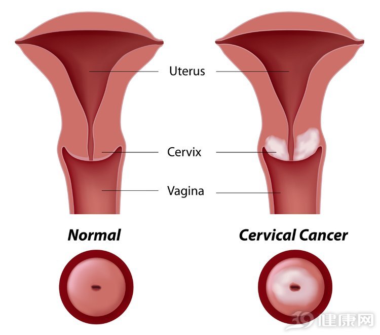 得了宫颈癌的6个早期症状,三个征兆说明已有宫颈癌