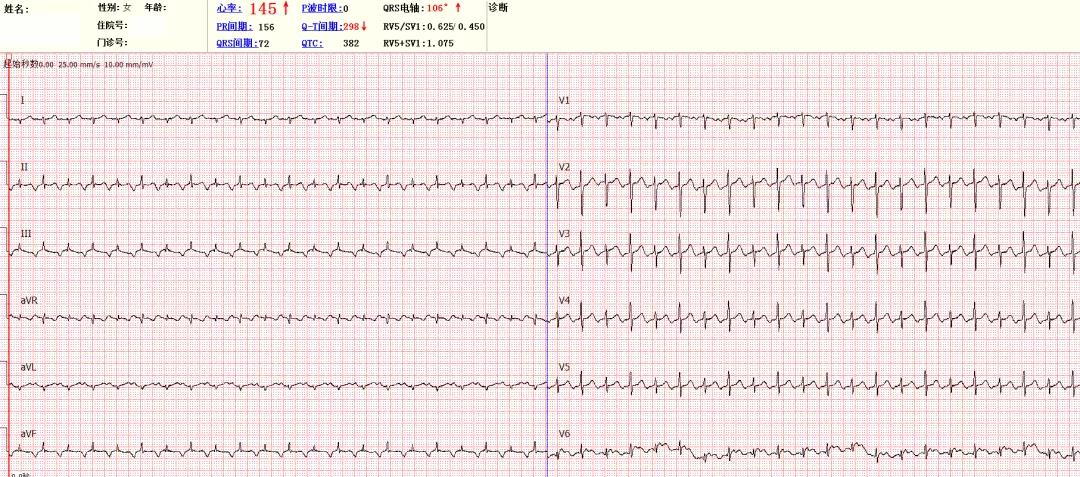 孕妇心率从170降下来,孕妈心率一到医院就高