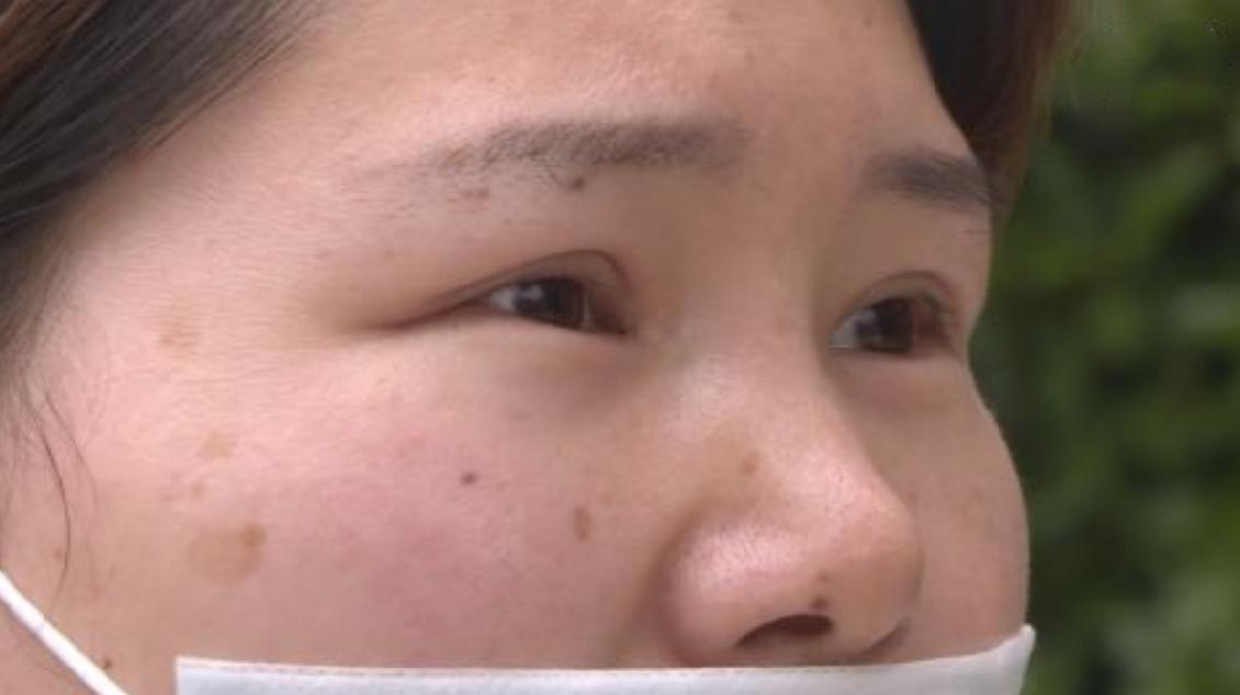 女子在家里自己做双眼皮手术,妻子经常在半夜梦里哭