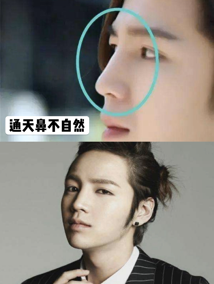 女人鼻子图解通天鼻,肋骨鼻做成了通天鼻怎么改