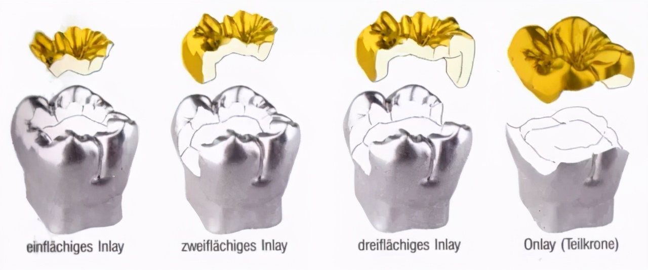 补牙的材料又掉了,补牙用一般材料好还是嵌体好