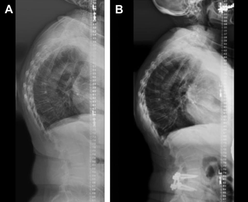 腰椎退行性变诊断书怎么写,腰椎退行性滑脱最好的治疗方法