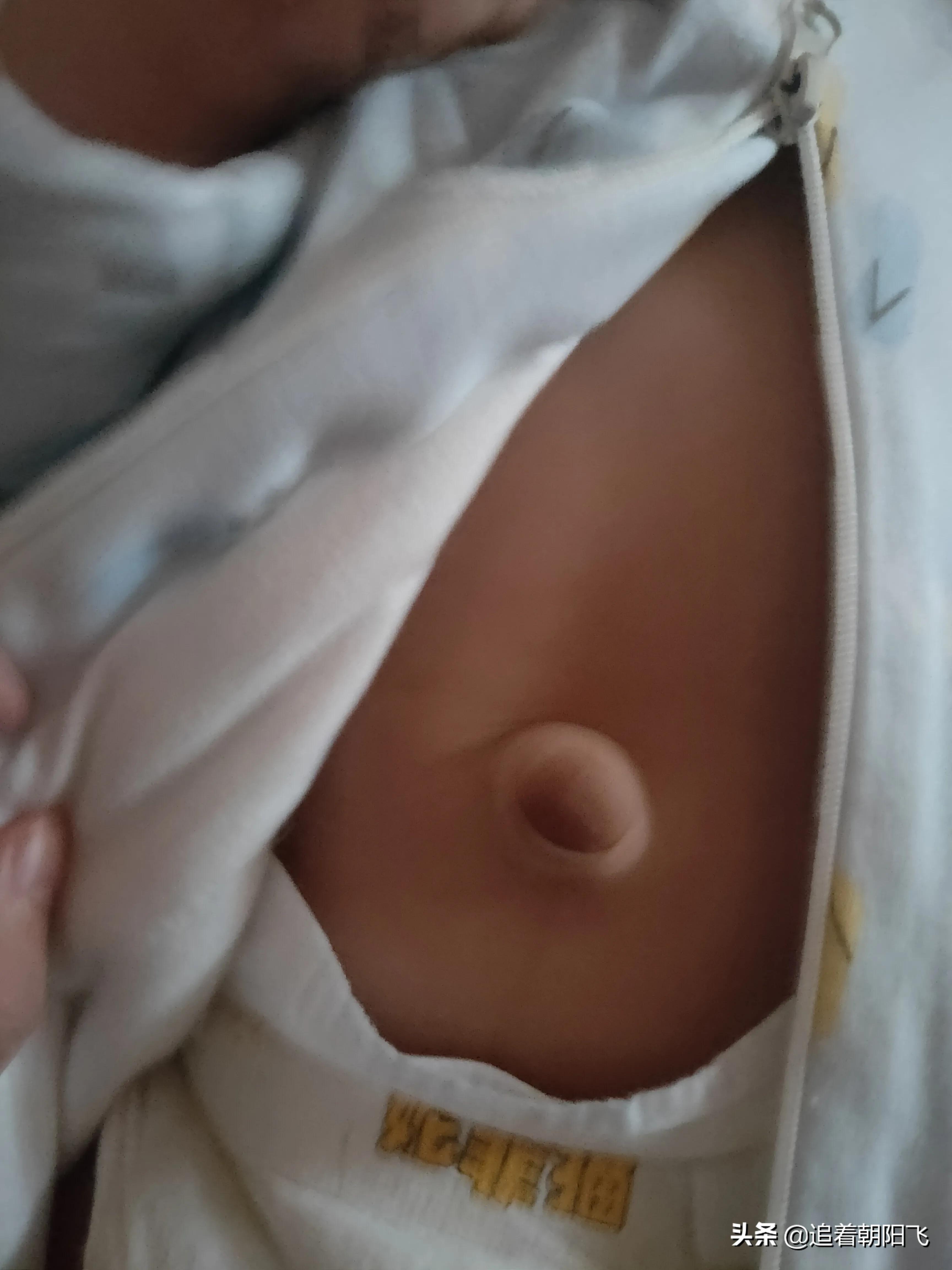宝贝肚脐有点突出怎么回事,有没有女宝宝肚脐眼凸出来的