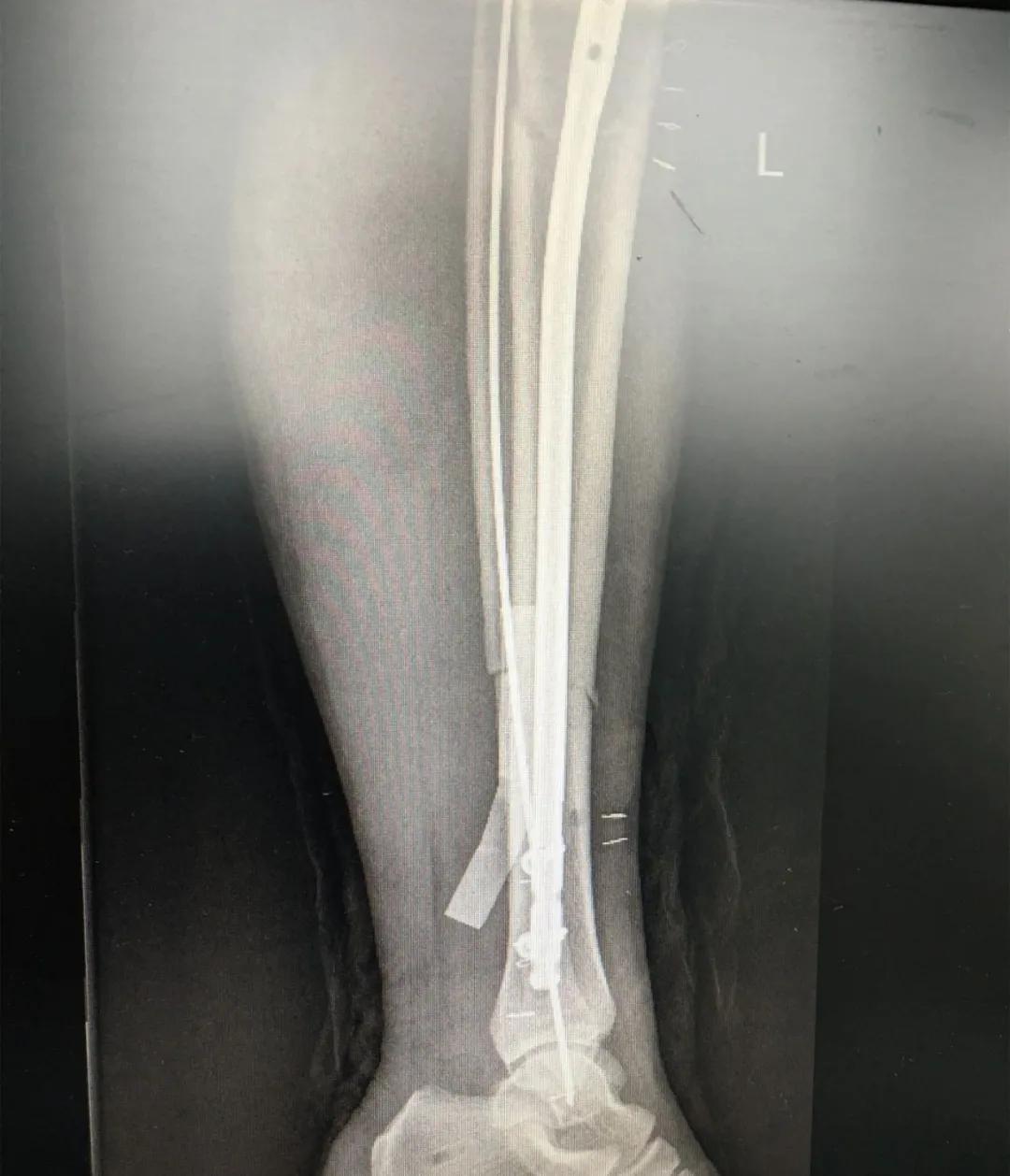 小腿挤压大量淤血能在家自愈吗,小腿碎成三截还能复原吗