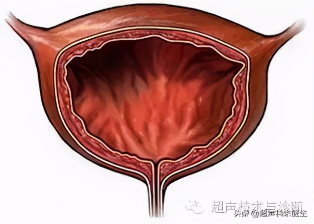 特殊性膀胱炎超声表现,特殊性膀胱炎吃什么药
