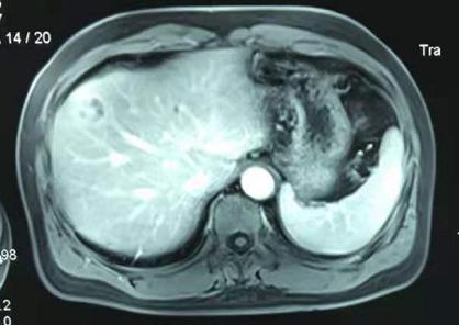 真假肿瘤实例！皆大欢喜背后源自于永不放弃