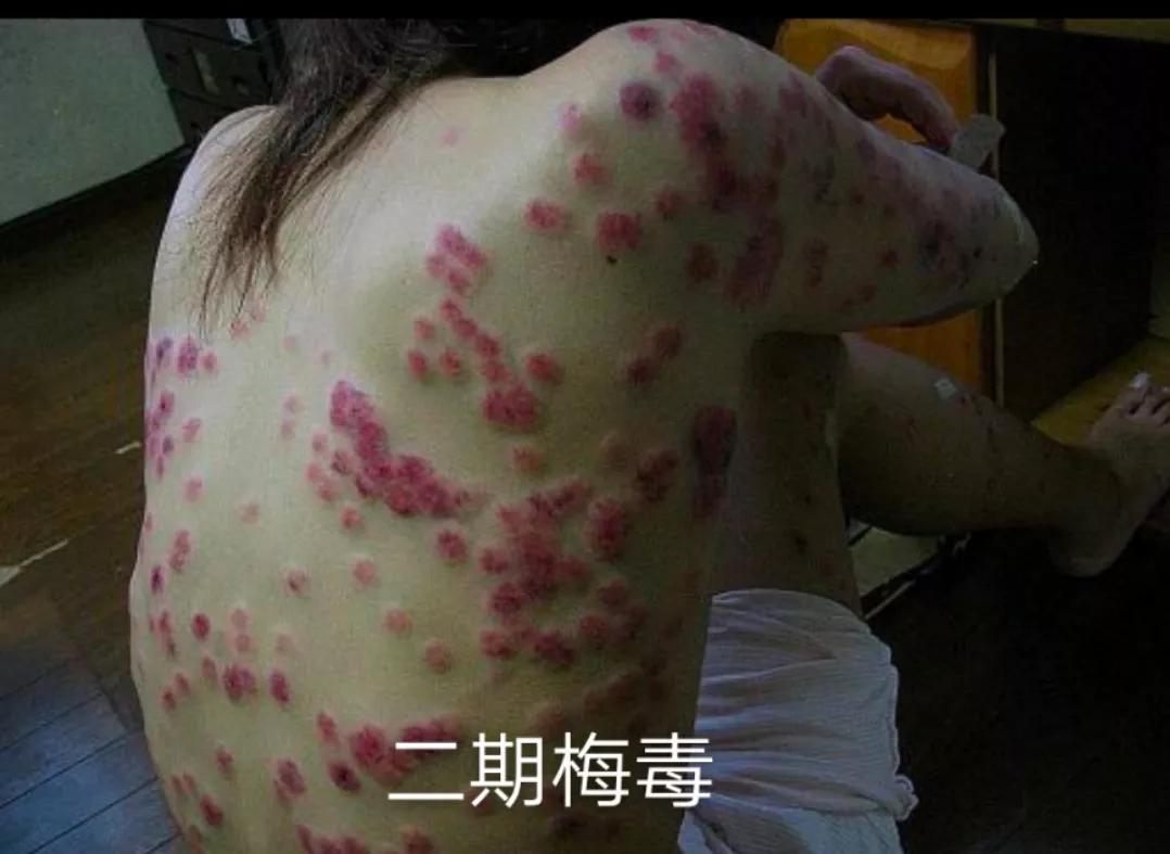 梅毒深入了解,怎样了解自己有没有梅毒