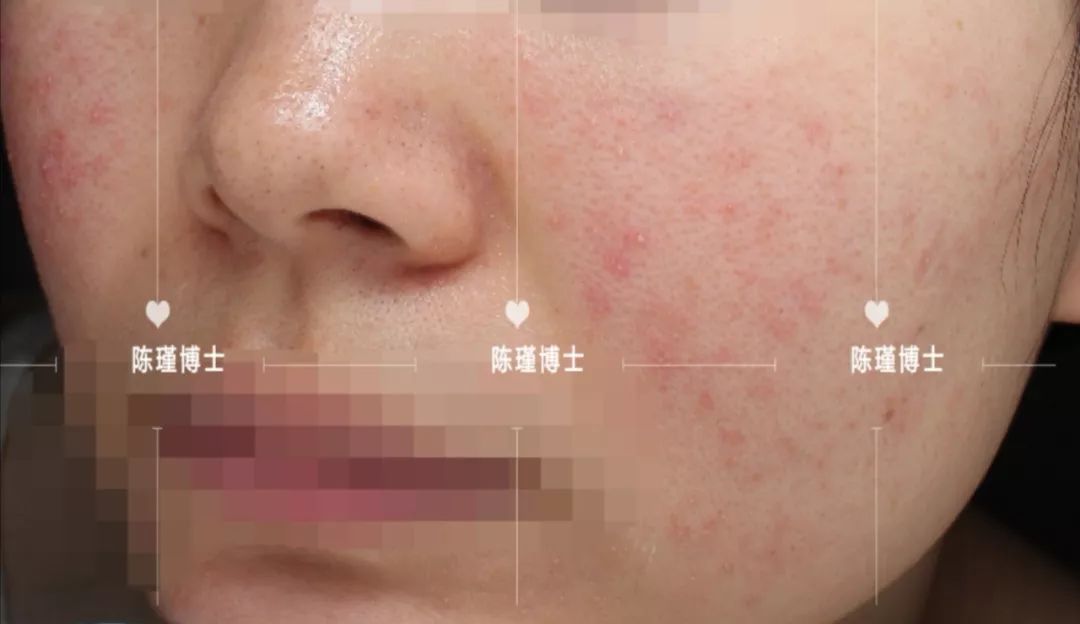 痘痘肌怎么刷酸效果好,痘痘肌刷酸的正确方法