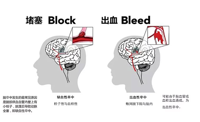 脑卒中科普知识及康复知识普及,早看早受益的方法