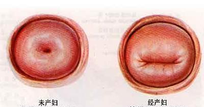 绝经5年又出血，妇科医生：取环要趁早，长到肉里太受罪