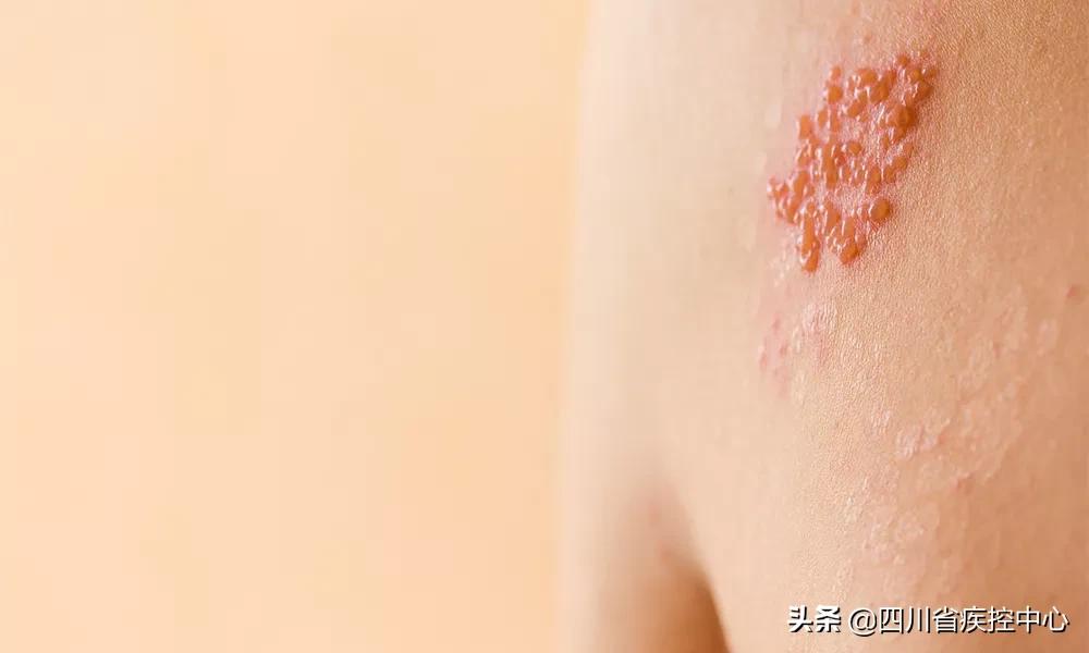 拿什么拯救你，连呼吸都痛的带状疱疹？