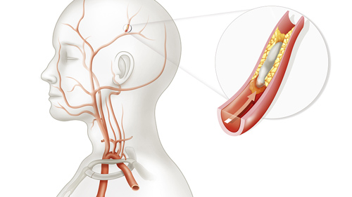 脑卒中后诱发癫痫是什么原因,癫痫的认知及最新治疗效果